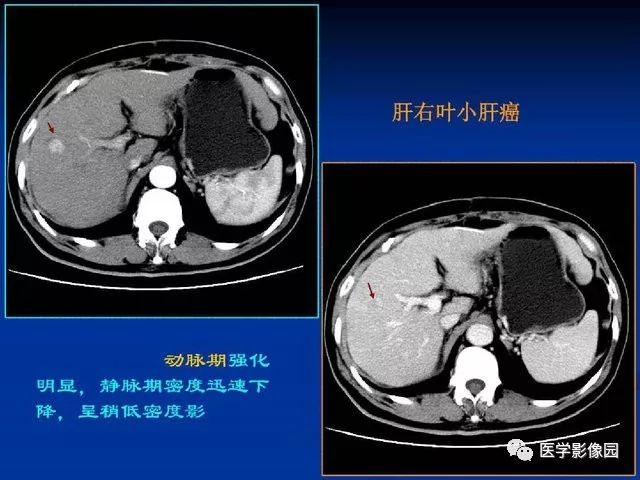 【PPT】原发性肝癌的CT技术和诊断指南