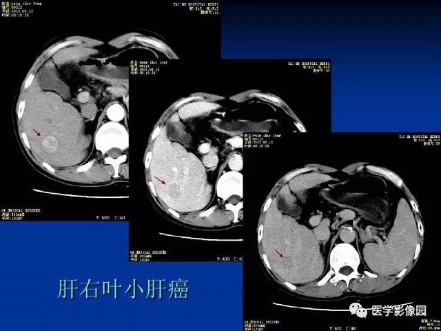 【PPT】原发性肝癌的CT技术和诊断指南