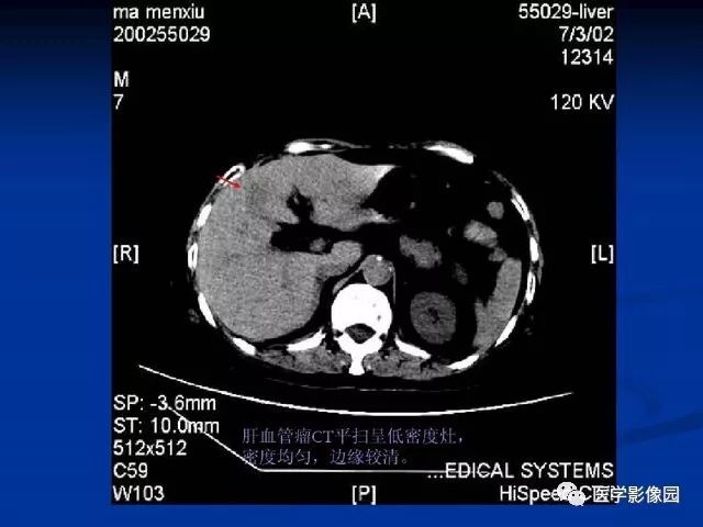 【PPT】原发性肝癌的CT技术和诊断指南