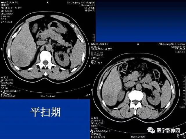 【PPT】原发性肝癌的CT技术和诊断指南
