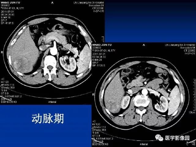 【PPT】原发性肝癌的CT技术和诊断指南