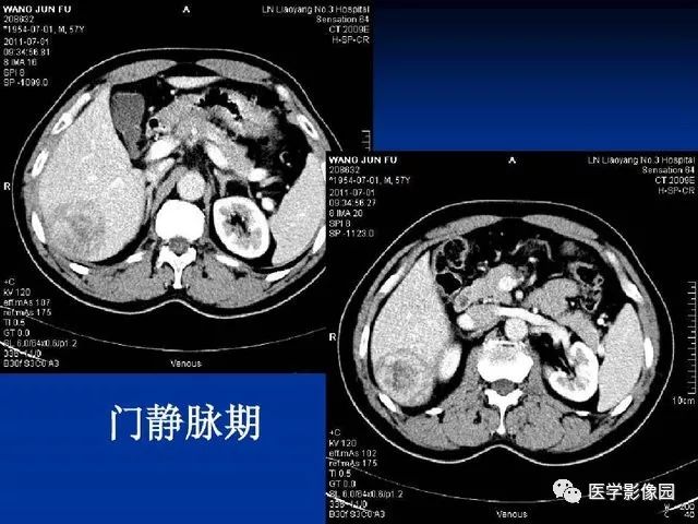 【PPT】原发性肝癌的CT技术和诊断指南