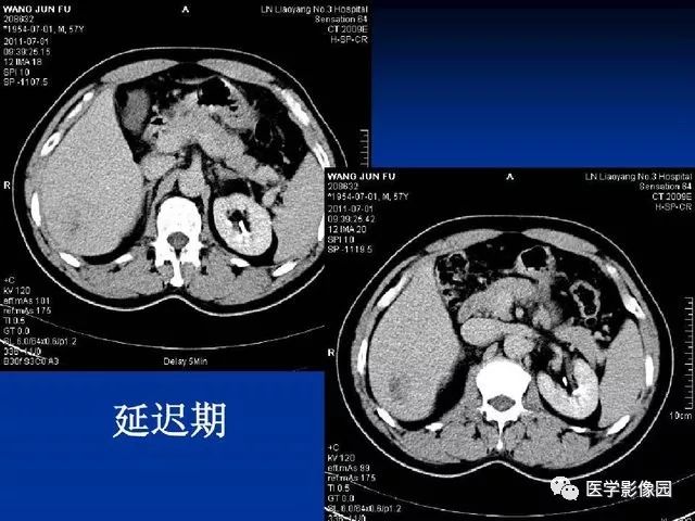 【PPT】原发性肝癌的CT技术和诊断指南