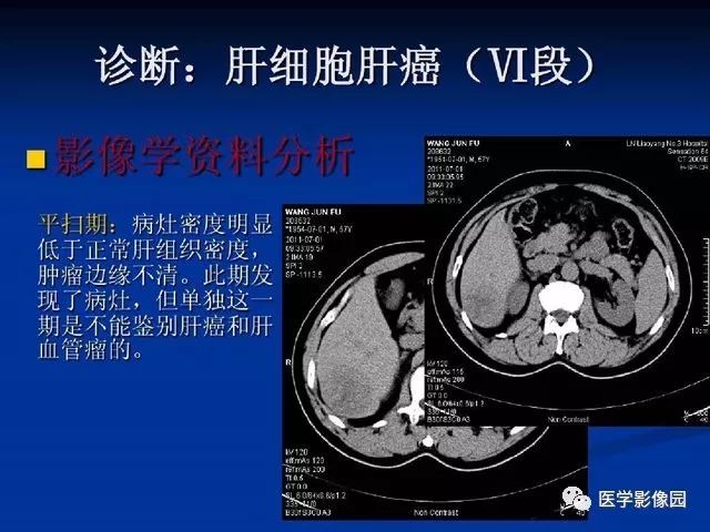 【PPT】原发性肝癌的CT技术和诊断指南