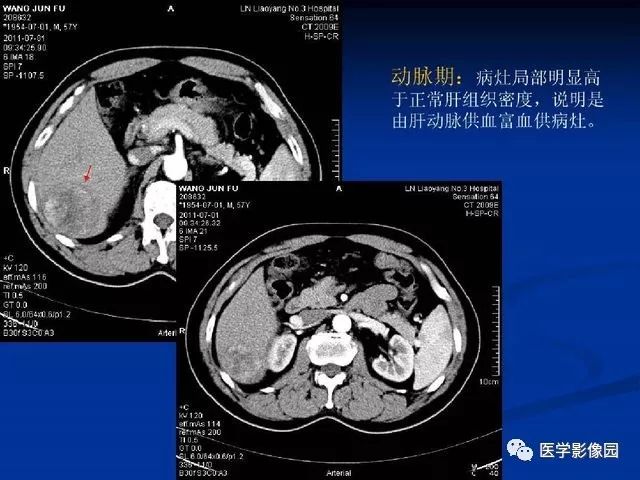 【PPT】原发性肝癌的CT技术和诊断指南