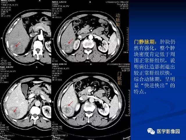 【PPT】原发性肝癌的CT技术和诊断指南
