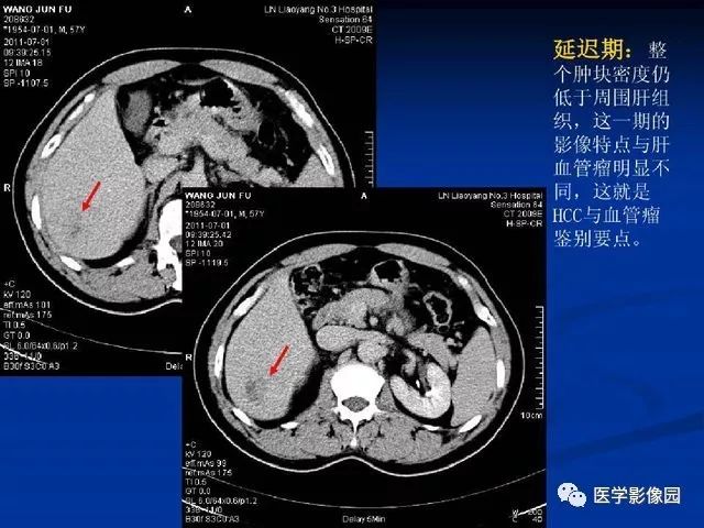 【PPT】原发性肝癌的CT技术和诊断指南