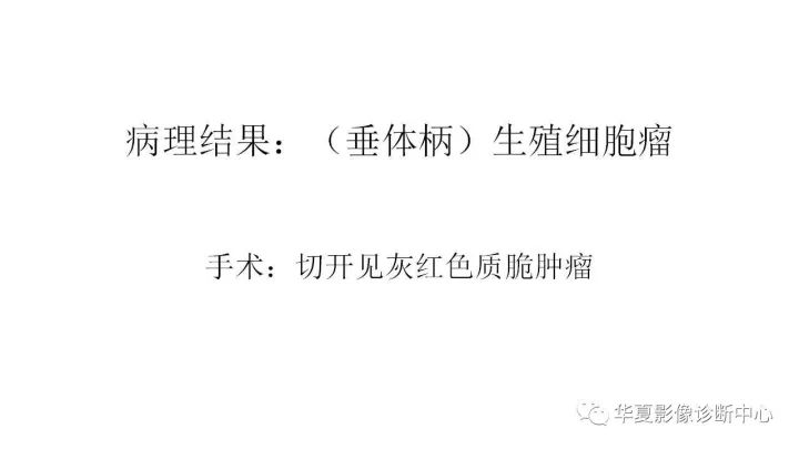 【病例】垂体柄升值细胞瘤1例MR