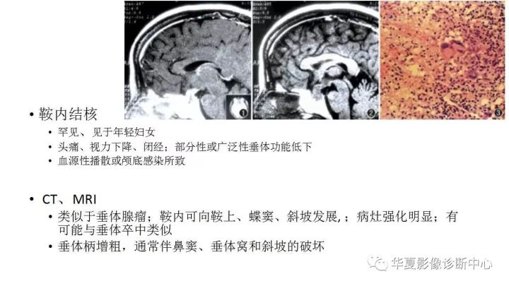 【病例】垂体柄升值细胞瘤1例MR