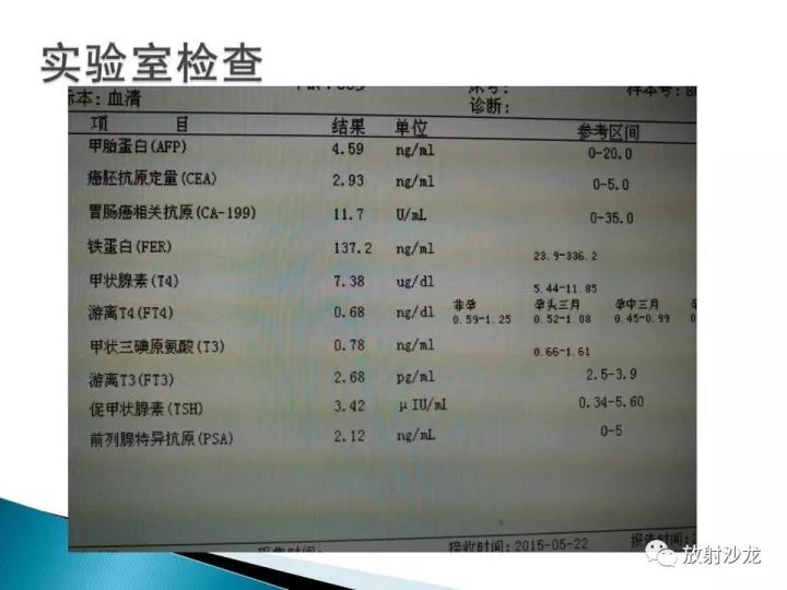 【病例】膀胱淋巴瘤1例CT影像表现
