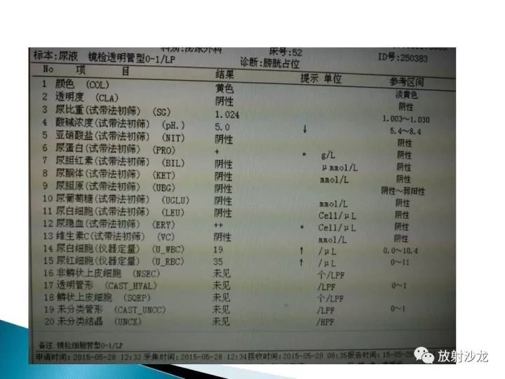 【病例】膀胱淋巴瘤1例CT影像表现