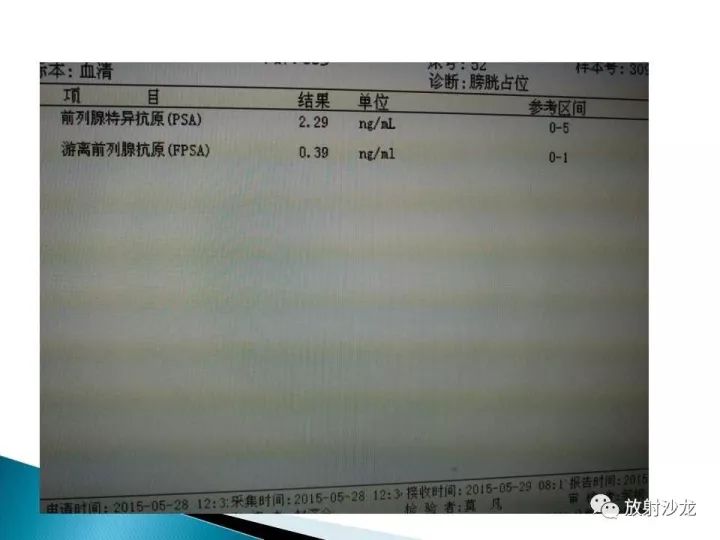 【病例】膀胱淋巴瘤1例CT影像表现