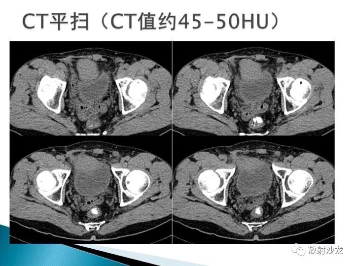 【病例】膀胱淋巴瘤1例CT影像表现