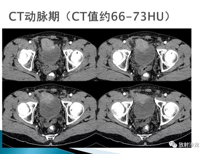 【病例】膀胱淋巴瘤1例CT影像表现