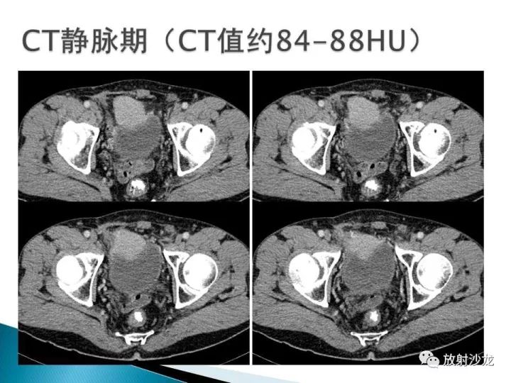 【病例】膀胱淋巴瘤1例CT影像表现