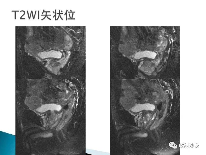 【病例】膀胱淋巴瘤1例CT影像表现
