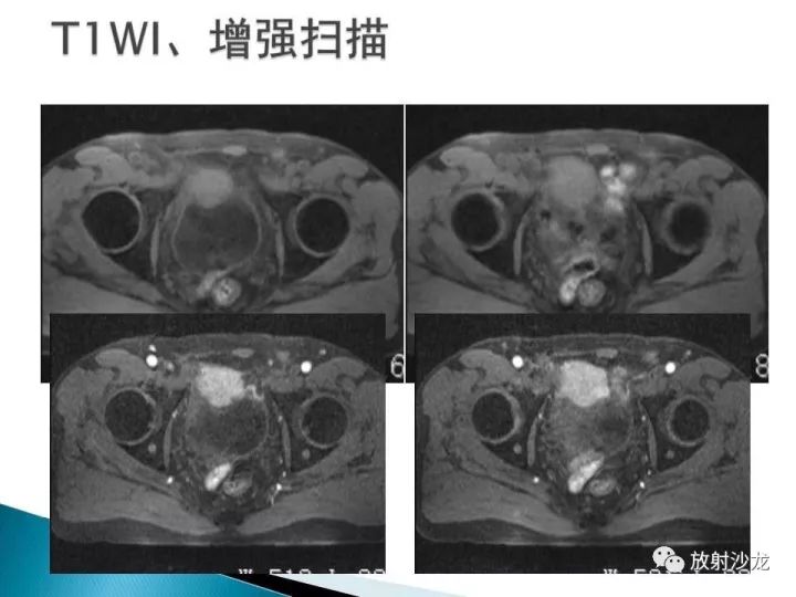 【病例】膀胱淋巴瘤1例CT影像表现