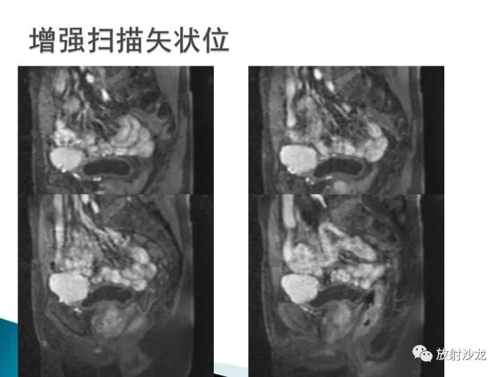【病例】膀胱淋巴瘤1例CT影像表现