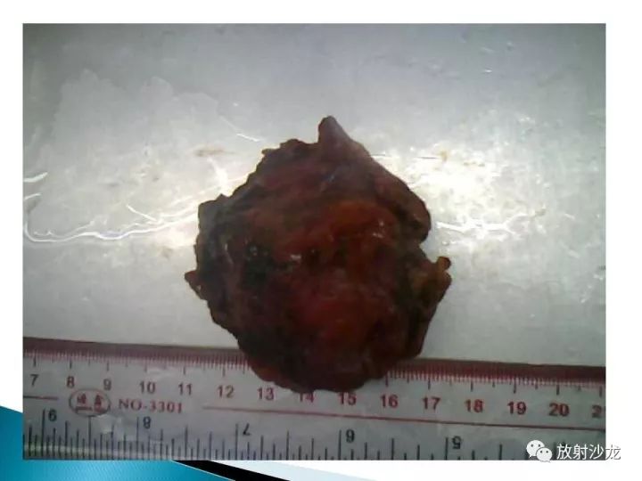 【病例】膀胱淋巴瘤1例CT影像表现