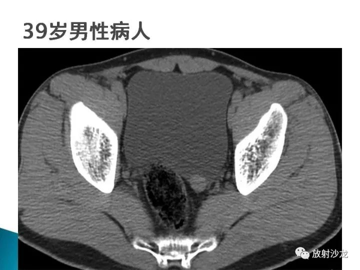 【病例】膀胱淋巴瘤1例CT影像表现
