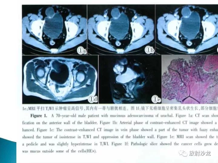 【病例】膀胱淋巴瘤1例CT影像表现