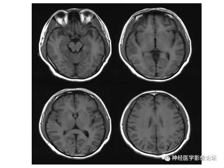 【病例】不多见苯中毒脑病一例MR 【病例】不多见苯中毒脑病一例MR