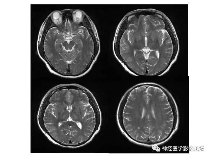 【病例】不多见苯中毒脑病一例MR 【病例】不多见苯中毒脑病一例MR