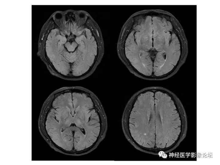 【病例】不多见苯中毒脑病一例MR 【病例】不多见苯中毒脑病一例MR