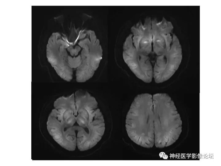 【病例】不多见苯中毒脑病一例MR