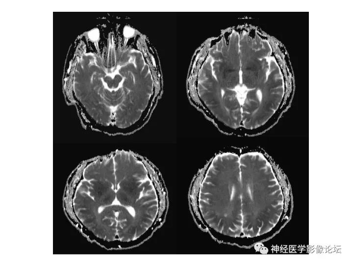 【病例】不多见苯中毒脑病一例MR 【病例】不多见苯中毒脑病一例MR