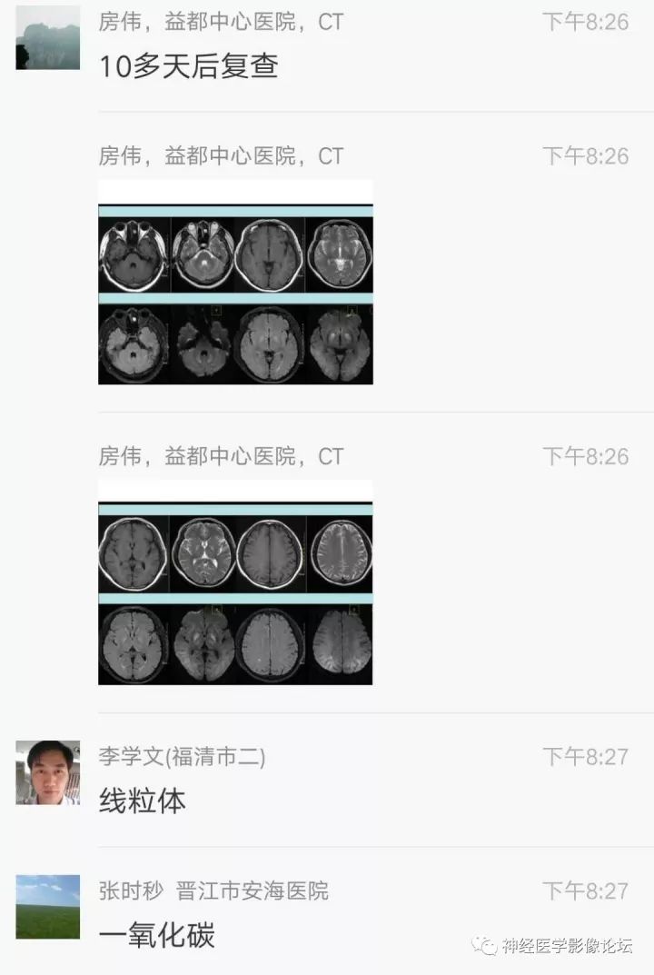 【病例】不多见苯中毒脑病一例MR 【病例】不多见苯中毒脑病一例MR