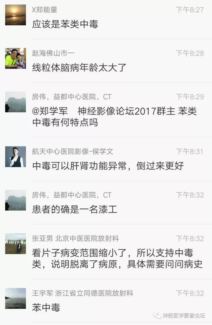 【病例】不多见苯中毒脑病一例MR 【病例】不多见苯中毒脑病一例MR