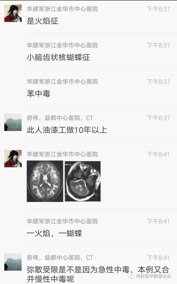 【病例】不多见苯中毒脑病一例MR 【病例】不多见苯中毒脑病一例MR