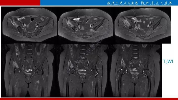 【病例】髂骨浆细胞性骨髓瘤1例MR影像诊断