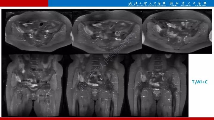 【病例】髂骨浆细胞性骨髓瘤1例MR影像诊断