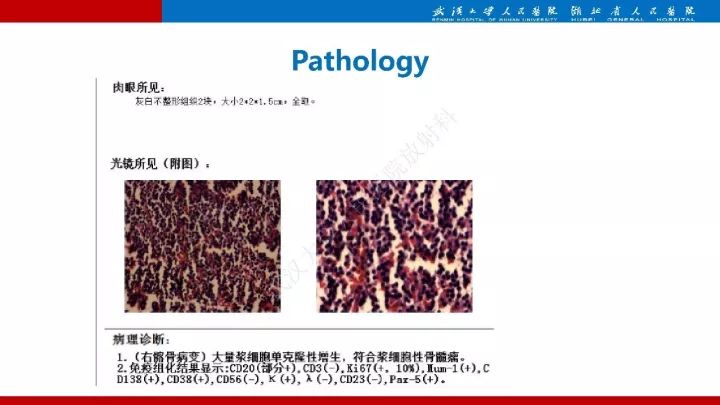 【病例】髂骨浆细胞性骨髓瘤1例MR影像诊断