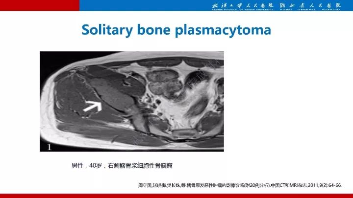 【病例】髂骨浆细胞性骨髓瘤1例MR影像诊断