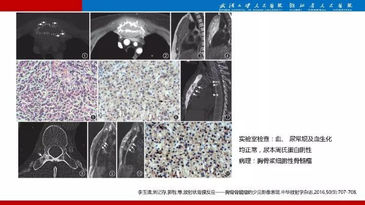 【病例】髂骨浆细胞性骨髓瘤1例MR影像诊断