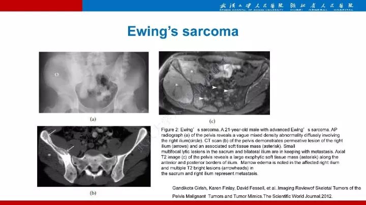 【病例】髂骨浆细胞性骨髓瘤1例MR影像诊断