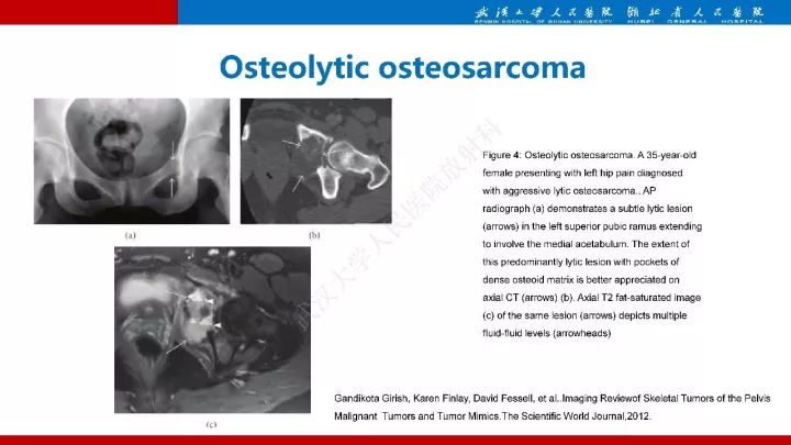 【病例】髂骨浆细胞性骨髓瘤1例MR影像诊断
