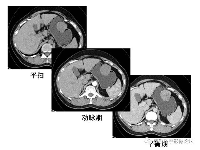 【病例】胃壁粘膜下占位3例CT影像表现