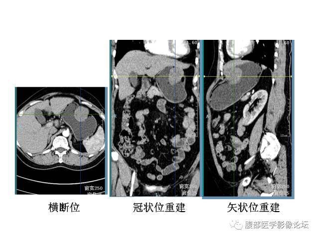 【病例】胃壁粘膜下占位3例CT影像表现