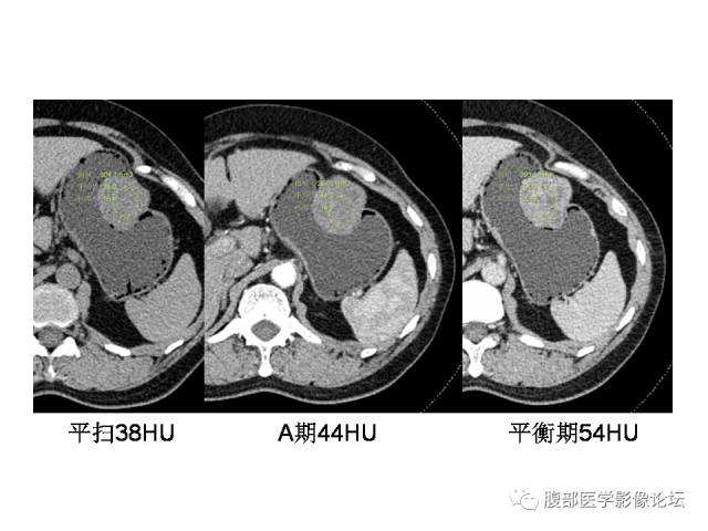【病例】胃壁粘膜下占位3例CT影像表现