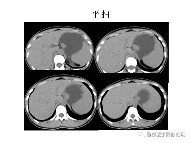 【病例】胃壁粘膜下占位3例CT影像表现