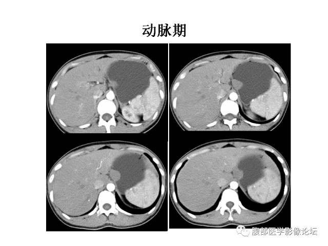 【病例】胃壁粘膜下占位3例CT影像表现