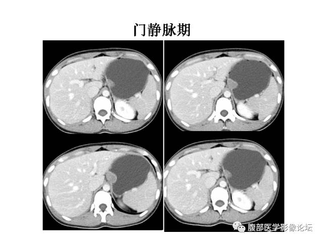 【病例】胃壁粘膜下占位3例CT影像表现