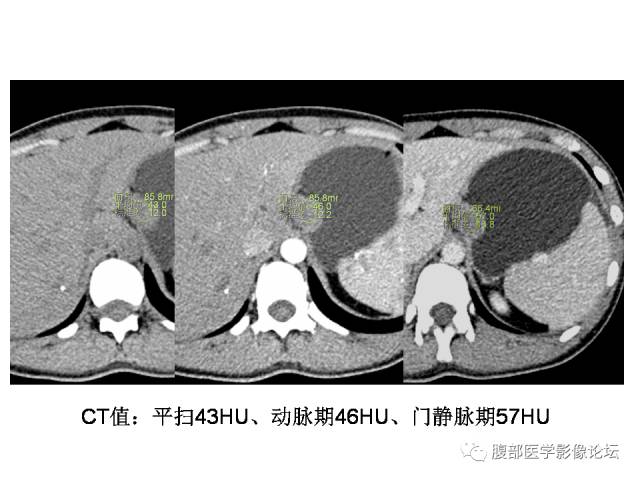 【病例】胃壁粘膜下占位3例CT影像表现