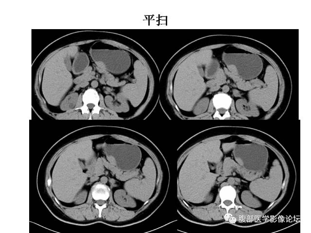【病例】胃壁粘膜下占位3例CT影像表现
