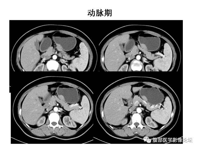 【病例】胃壁粘膜下占位3例CT影像表现