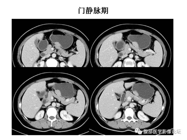 【病例】胃壁粘膜下占位3例CT影像表现